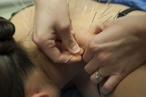 Acupuncture for Chronic Pain